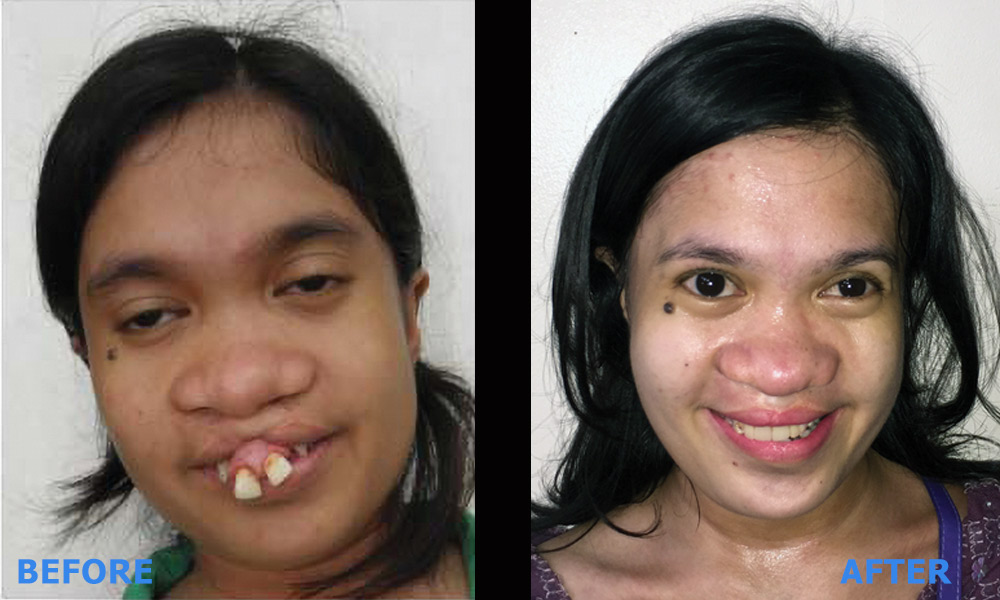 Alora's cleft surgery, before and after