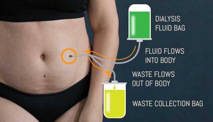 Peritoneal dialysis example: belly port and bags